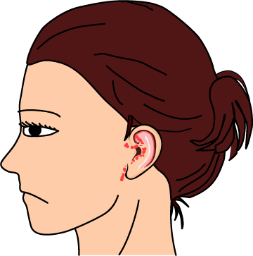 ハント症候群における耳周りの水疱（ヘルペス）