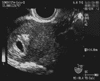 不妊症･不育症治療 超音波（イメージ）